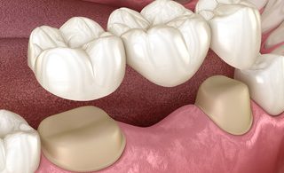 Will A Dental Bridge Last for a Lifetime?