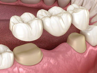 Will A Dental Bridge Last for a Lifetime?