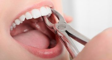 Tooth Extraction