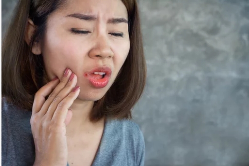 How to Cure Mouth Ulcers Fast Naturally