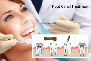 Root canal treatment