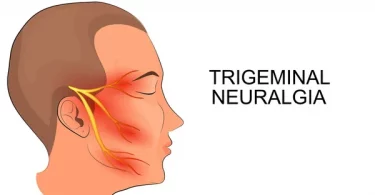 Facial Nerve Pain