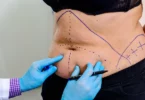 Exploring Non-Surgical Alternatives to Tummy Tucks: What’s New in Body Contouring?